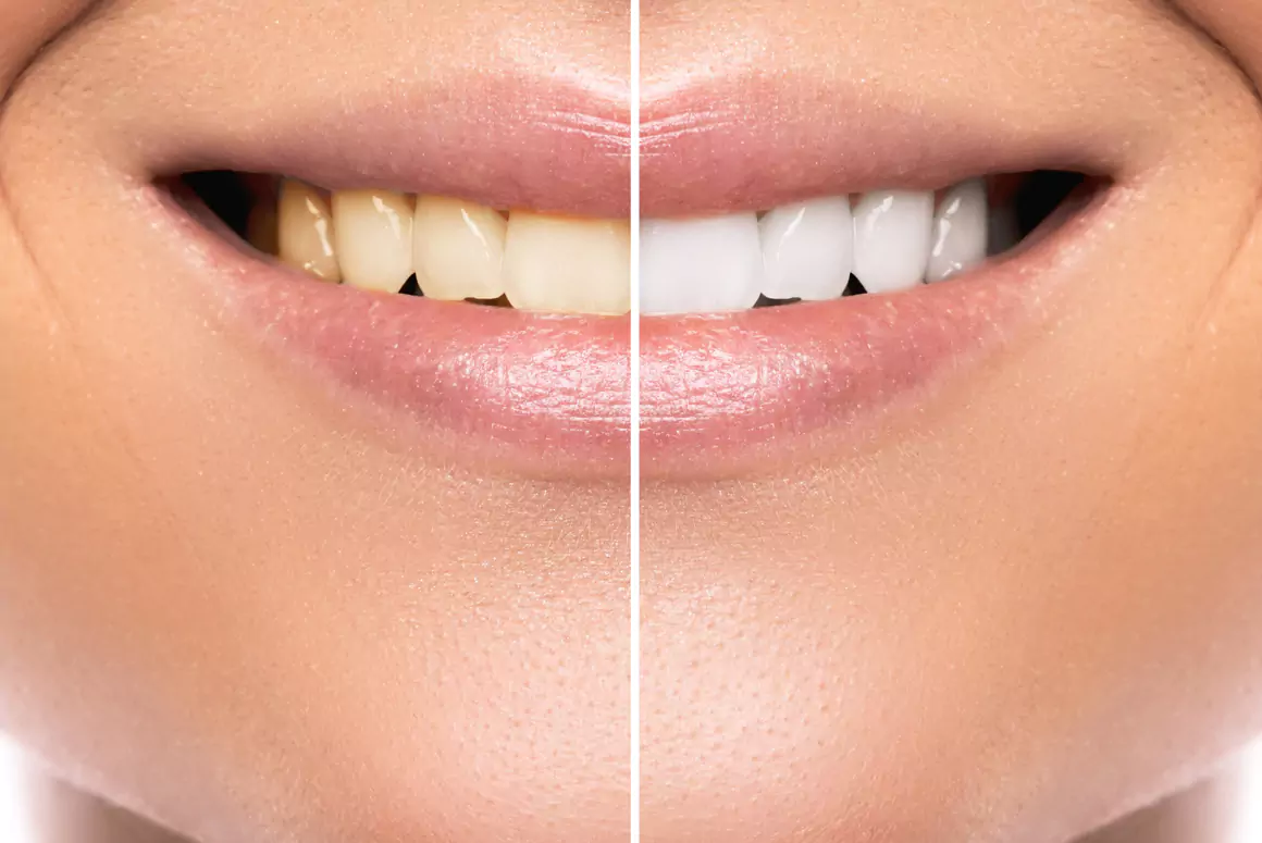 The Best Time to Whiten Your Teeth Before an Event