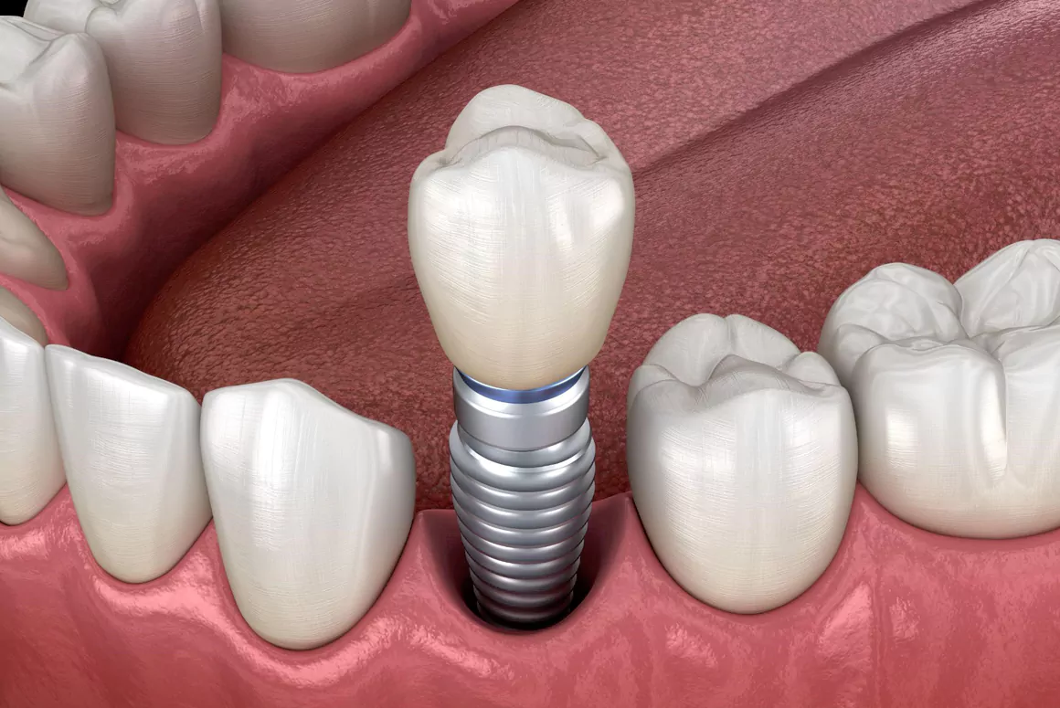 Why More Adults Over 50 are Choosing Dental Implants in Wimbledon