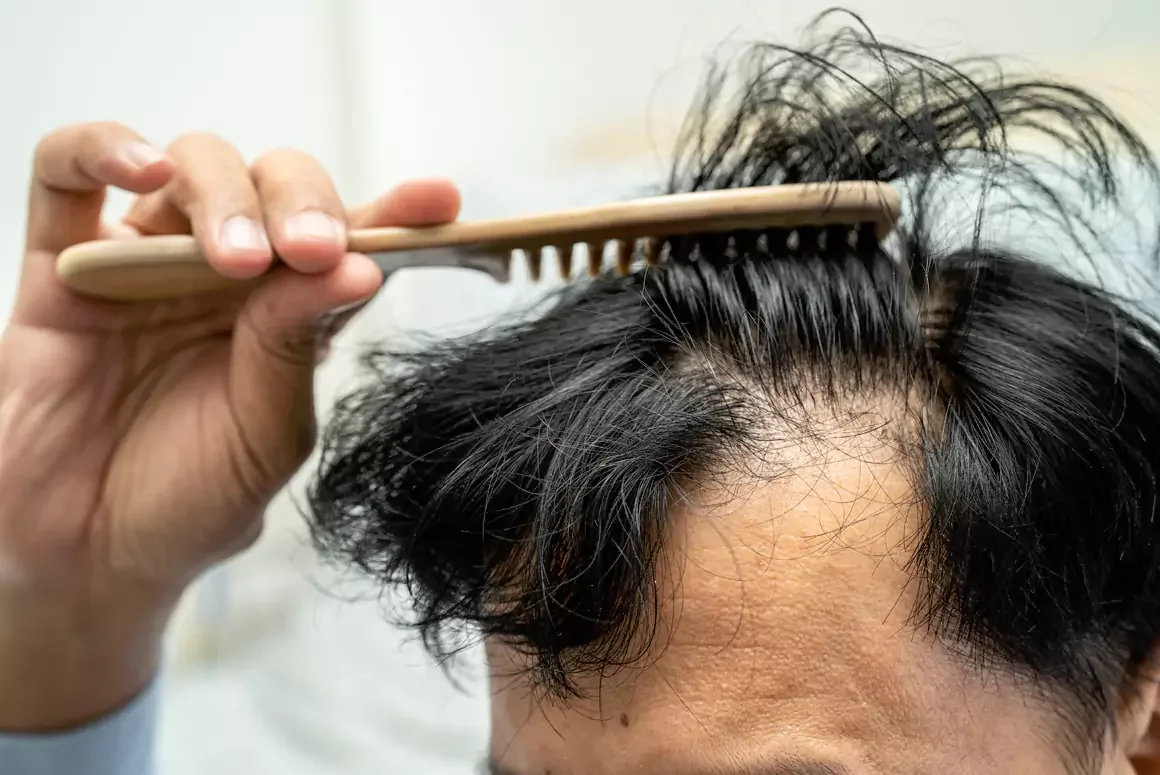 How the UK Compares to Overseas Hair Transplant Markets